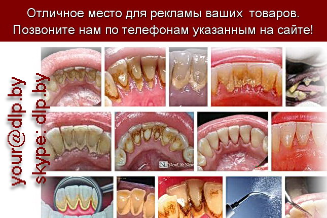 Запрос: «зубной камень», рубрика: Медицина
